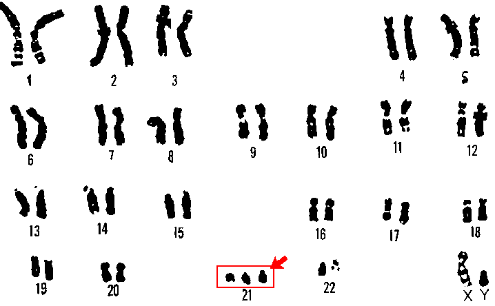 Karyogramm eines Menschen mit drei Exemplaren von Chromosom 21 (Trisomie 21)